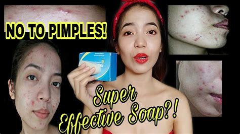 SABON NA PAMPAWALA NG TIGYAWAT O PIMPLES! (Skin .